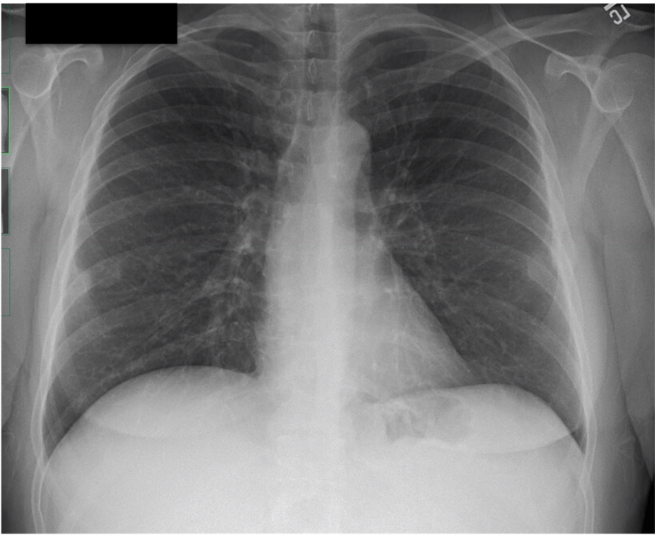 Pulmonary Function Tests | PulmPEEPs